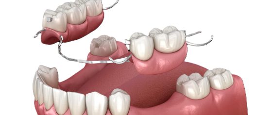 Removable dentures at Tandhälsan A6 Jönköping - Dentists in Jönköping