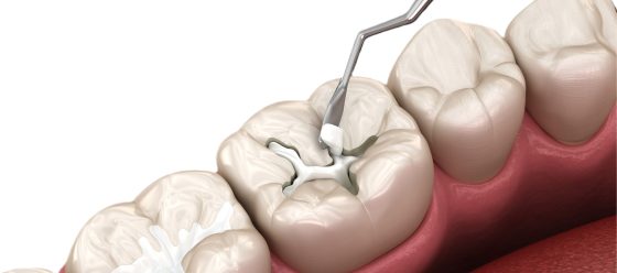 Dental repair using composite and dental tools at Tandhälsan A6 Jönköping - Dentists in Jönköping